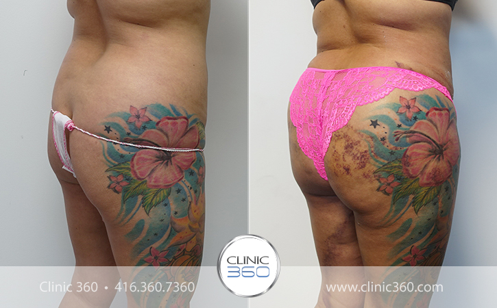 Brazilian Butt Lift Before & After Photos - Clinic 360