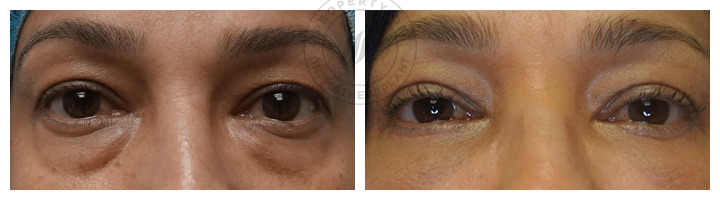 Blepharoplasty Before & After Photos - Clinic 360