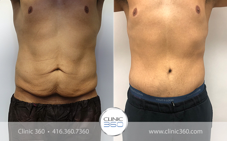 Tummy Tuck Before & After Photos - Clinic 360