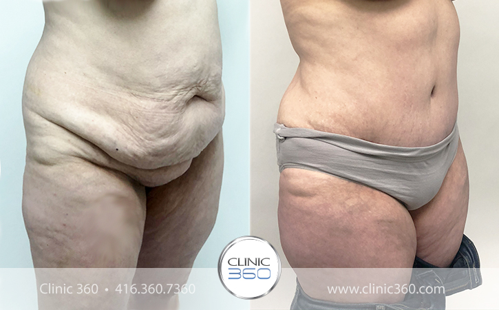 Tummy Tuck Before & After Photos - Clinic 360