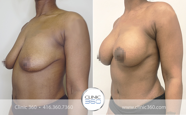 Breast Lift Before & After Photos - Clinic 360