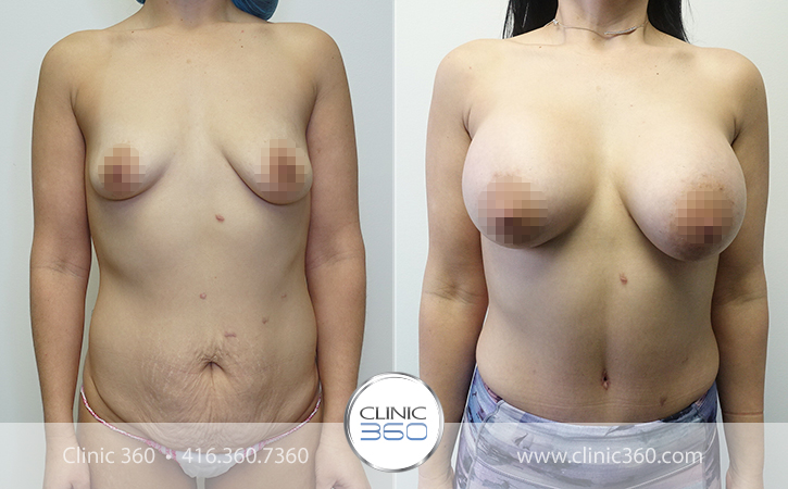 Mommy Makeover Before & After Photos - Clinic 360