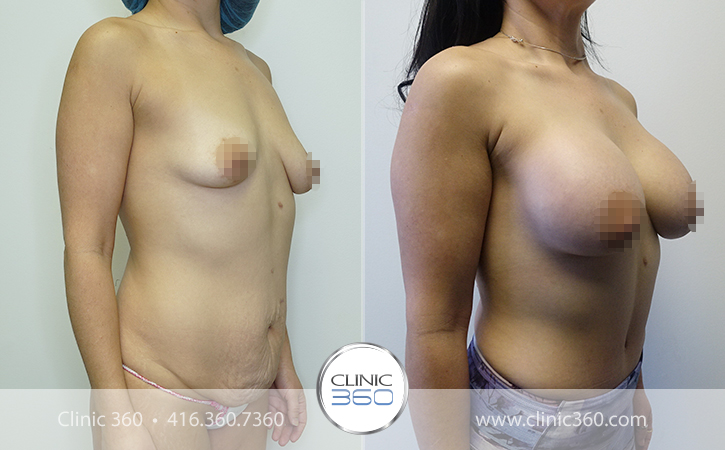 Mommy Makeover Before & After Photos - Clinic 360